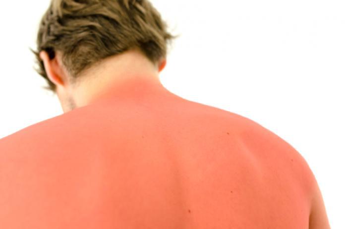 Sunburns And Protecting Your Skin