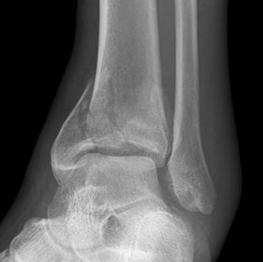 sprained ankle x ray